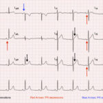 Acute Pericarditis: Electrocardiogram 1 Creative Commons images