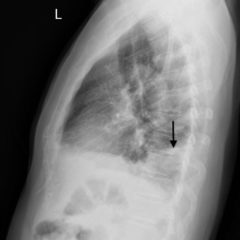 Hampton’s Hump in Pulmonary Embolism 5 Creative Commons images