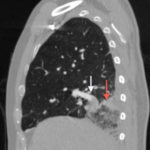 Hampton’s Hump in Pulmonary Embolism 1 Creative Commons images