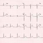 Acute Pericarditis: Electrocardiogram 2 Creative Commons images
