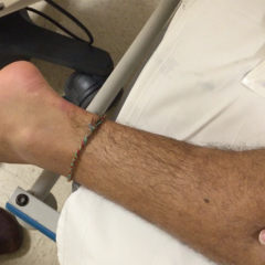 Thompson Test in Achilles Tendon Rupture 6 Creative Commons images