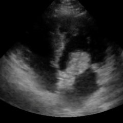 Atrial Myxoma 5 Creative Commons images