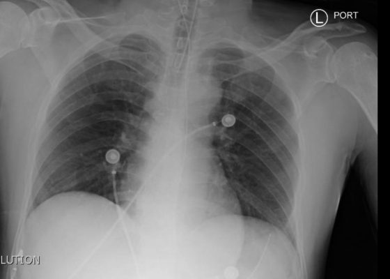 Normal CXR and Post-Intubation CXR 10 post intubation chest x-ray