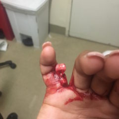Open Dislocation of Fifth Digit 8 5th Finger Dislocation Photograph JETem 2016