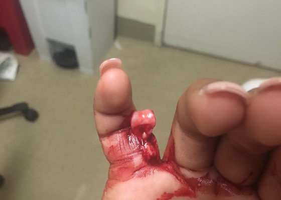 Open Dislocation of Fifth Digit 12 5th Finger Dislocation Photograph JETem 2016