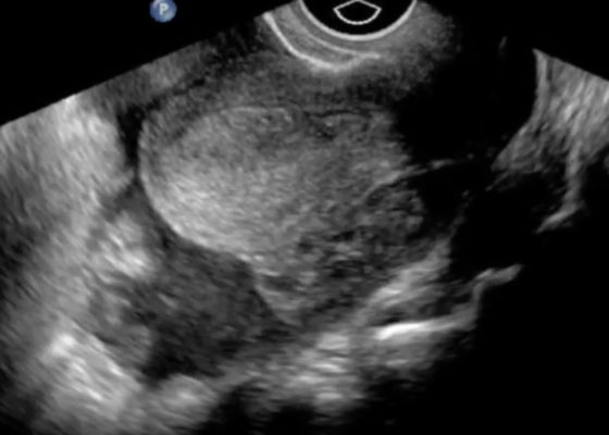 Ruptured Ectopic Pregnancy 12 Ectopic Still JETem 2016