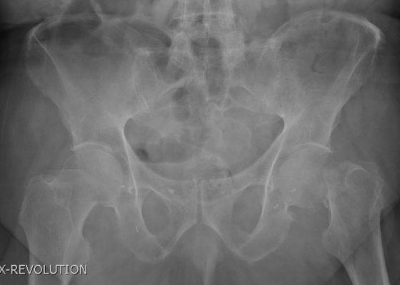 Femoral Neck Fracture 6 Femoral Neck Fracture, AP Xray. JETem 2016