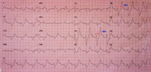 Hyperkalemia ECG, Annotated. JETem 2016