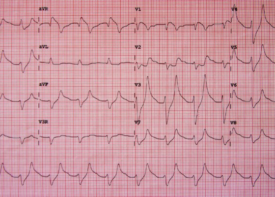 Hyperkalemia ECG JETem 2016