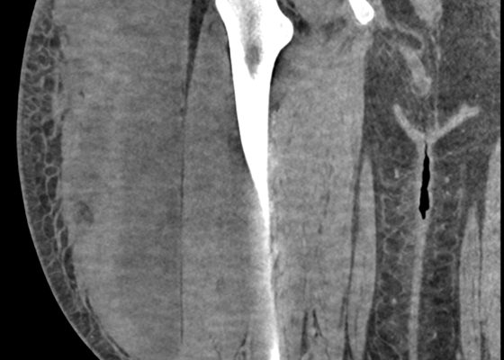 Morel-Lavallée Lesion 14 Morel Lavalee Lesion