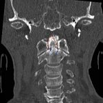 Odontoid Fracture: Computed Tomography 2 Creative Commons images