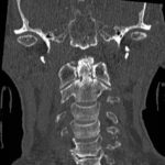 Odontoid Fracture: Computed Tomography 4 Odontoid Fracture, CT Coronal. JETem 2016