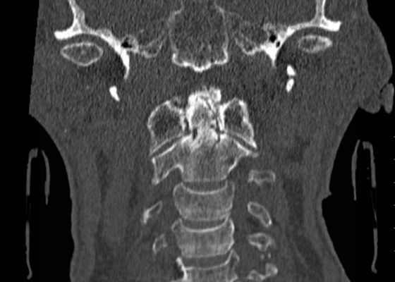 Odontoid Fracture: Computed Tomography 10 Odontoid Fracture, CT Coronal. JETem 2016