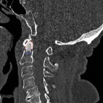 Odontoid Fracture: Computed Tomography 1 Creative Commons images