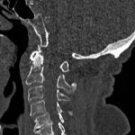 Odontoid Fracture: Computed Tomography 3 Odontoid Fracture, CT Sagittal. JETem 2016