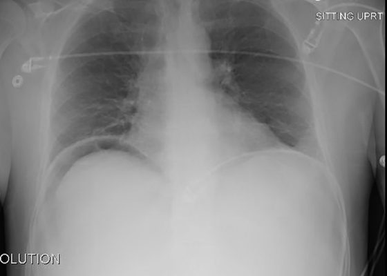 Perforated Duodenal Ulcer 14 Creative Commons images