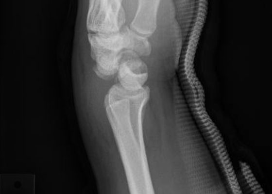 Perilunate Dislocation 4 Perilunate Dislocation, XRay. JETem 2016