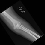 Posterior Elbow Dislocation 8 Posterior Elbow Dislocation, AP XRay, reduced. JETem 2016