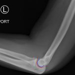 Posterior Elbow Dislocation 4 Creative Commons images