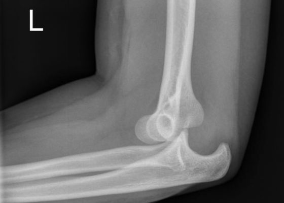 Posterior Elbow Dislocation 8 Posterior Elbow Dislocation, Lateral Xray, dislocated. JETem 2016