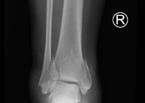 Trimalleolar Fracture 2 Creative Commons images