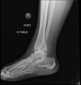 Trimalleolar Fracture, Lateral XRay. JETem 2016