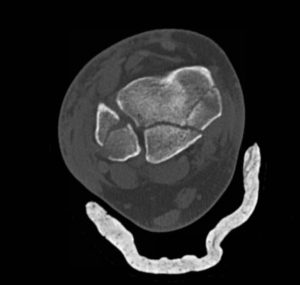 Trimalleolar Frcture, Transverse CT. JETem 2016