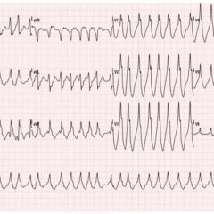 Wolff-Parkinson-White Syndrome: Electrocardiogram 13 WPW EKG 1, initial EKG. JETem 2016