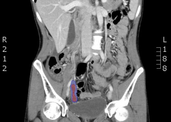 Computed Tomography Diagnosis of Appendicitis 8 Creative Commons images