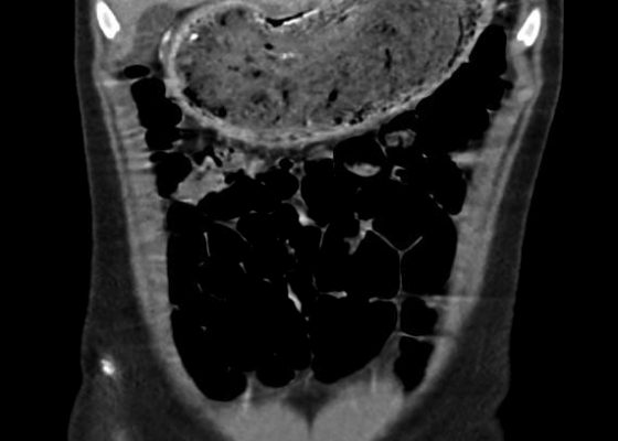 Gastric Bezoar 10 Creative Commons images