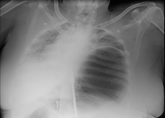 An Elderly Female with Dyspnea and Abdominal Pain 6 Creative Commons images