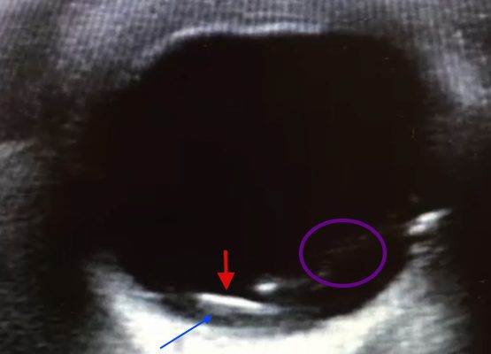 Intraocular Foreign Body: Ultrasound and CT Findings 14 Creative Commons images