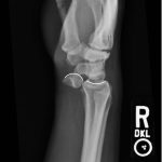 Lunate Dislocation 1 Creative Commons images