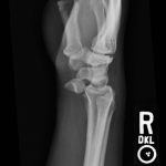 Lunate Dislocation 2 Creative Commons images