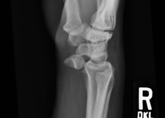 Lunate Dislocation 4 Creative Commons images