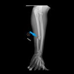 Monteggia Fracture in an Assault Patient 2 Creative Commons images