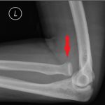 Monteggia Fracture in an Assault Patient 4 Creative Commons images