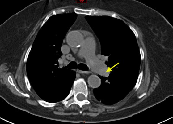Pulmonary Embolism: Diagnosis by Computerized Tomography without Intravenous Contrast 8 Creative Commons images