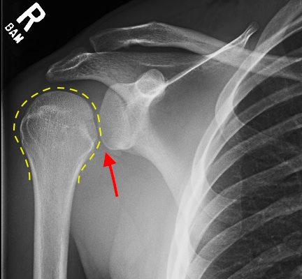 Irreducible Traumatic Posterior Shoulder Dislocation 10 Creative Commons images
