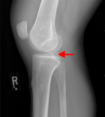 Pseudogout and Calcium Pyrophosphate Disease 12 Creative Commons images