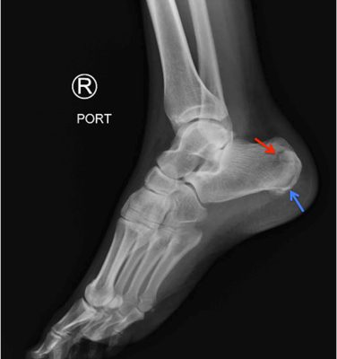 Calcaneal Fractures and Böhler’s Angle 12 Creative Commons images