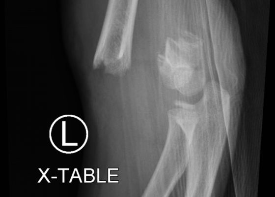 Pediatric Supracondylar Fracture 10 Creative Commons images