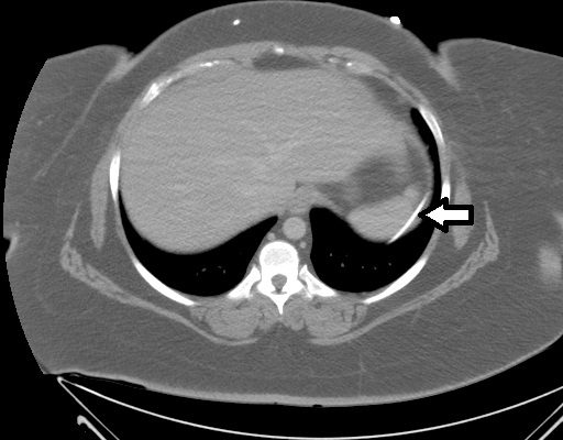 Ventriculoperitoneal Shunt Migration 6 Creative Commons images