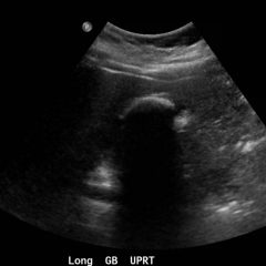 Cholelithiasis: WES Sign 9 Creative Commons images