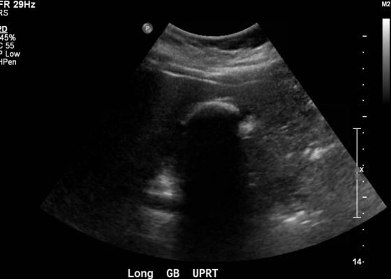 Cholelithiasis: WES Sign 12 Creative Commons images