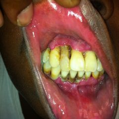 Acute Necrotizing Ulcerative Gingivitis (ANUG) 7 Creative Commons images