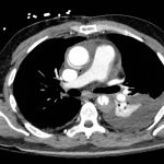 Acute Aortic Dissection Presenting Exclusively as Lower Extremity Paresthesias 6 Creative Commons images