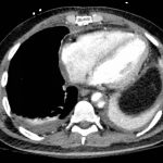 Acute Aortic Dissection Presenting Exclusively as Lower Extremity Paresthesias 7 Creative Commons images