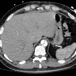 Acute Aortic Dissection Presenting Exclusively as Lower Extremity Paresthesias 8 Creative Commons images