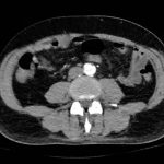 Acute Aortic Dissection Presenting Exclusively as Lower Extremity Paresthesias 10 Creative Commons images